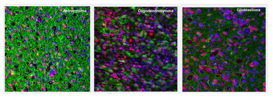 New Glioma Markers from Atlas Antibodies