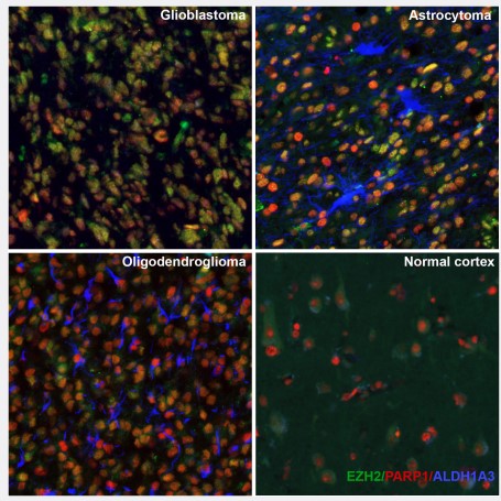 New TME-targeting glioma markers