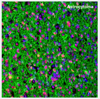 Astrocytoma