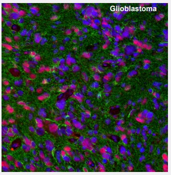 Glioblastoma
