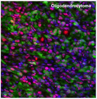Oligodendrocytoma